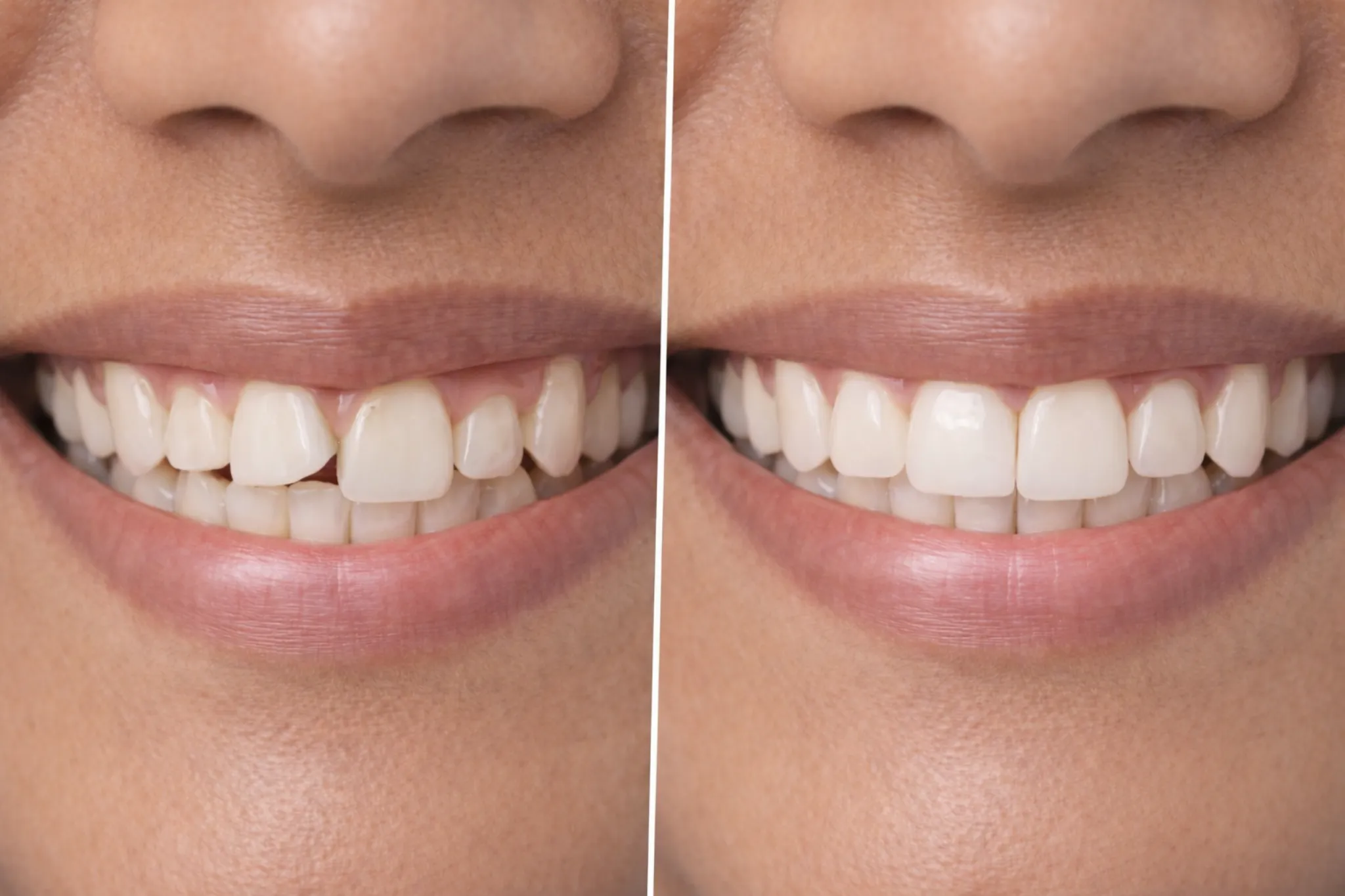 Braces Treatment Process